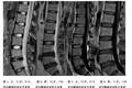 正常人椎間盤的MRI變化及可能因素對臨床治療的指導(dǎo)價值