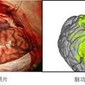 基于顱內腦電的高精度腦功能映射與神經監(jiān)護系統(tǒng)