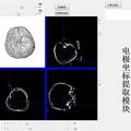 基于顱內(nèi)腦電的高精度腦功能映射與神經(jīng)監(jiān)護系統(tǒng)